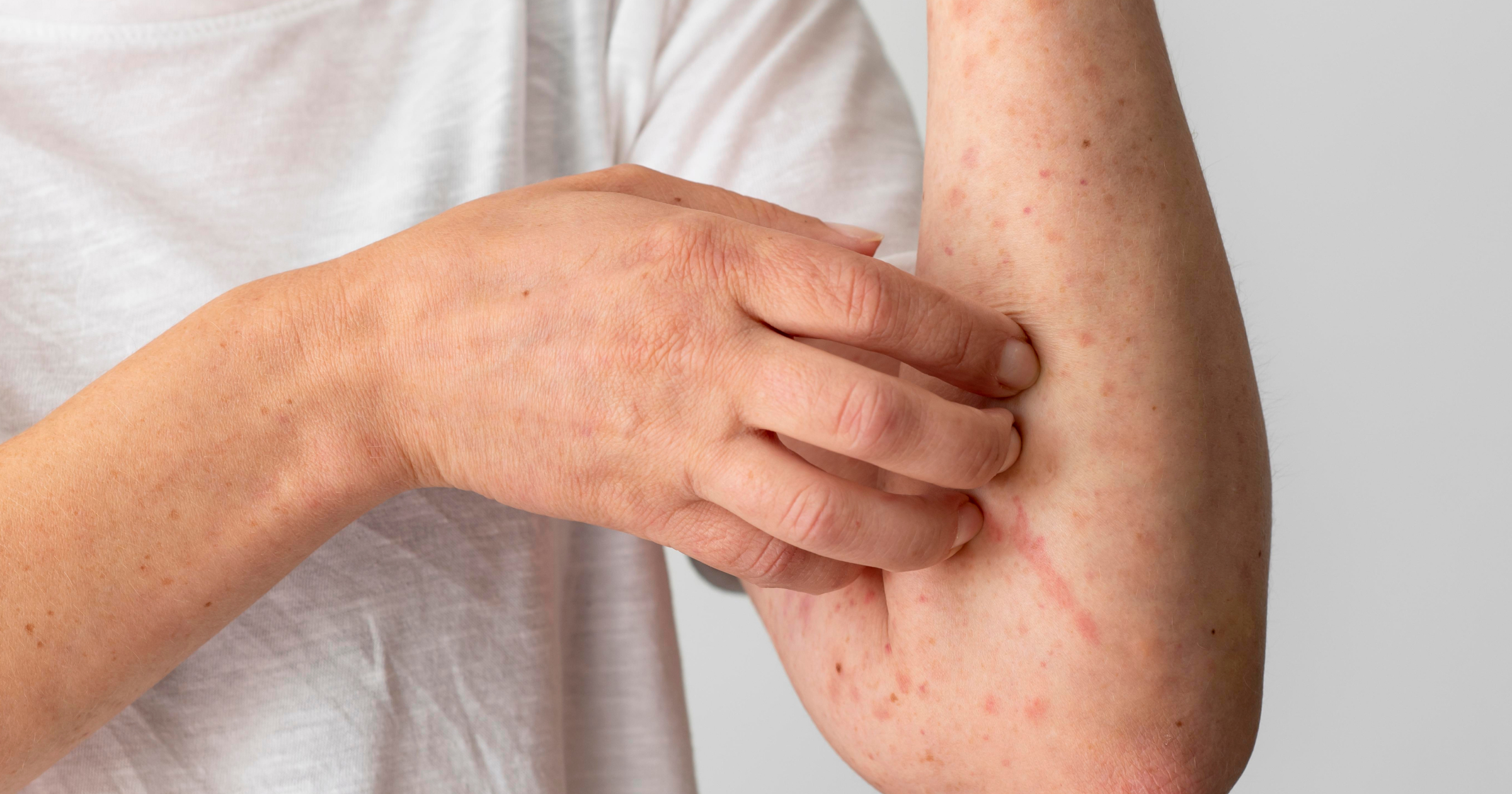 IMG-Understanding-Different-Eczema-Types